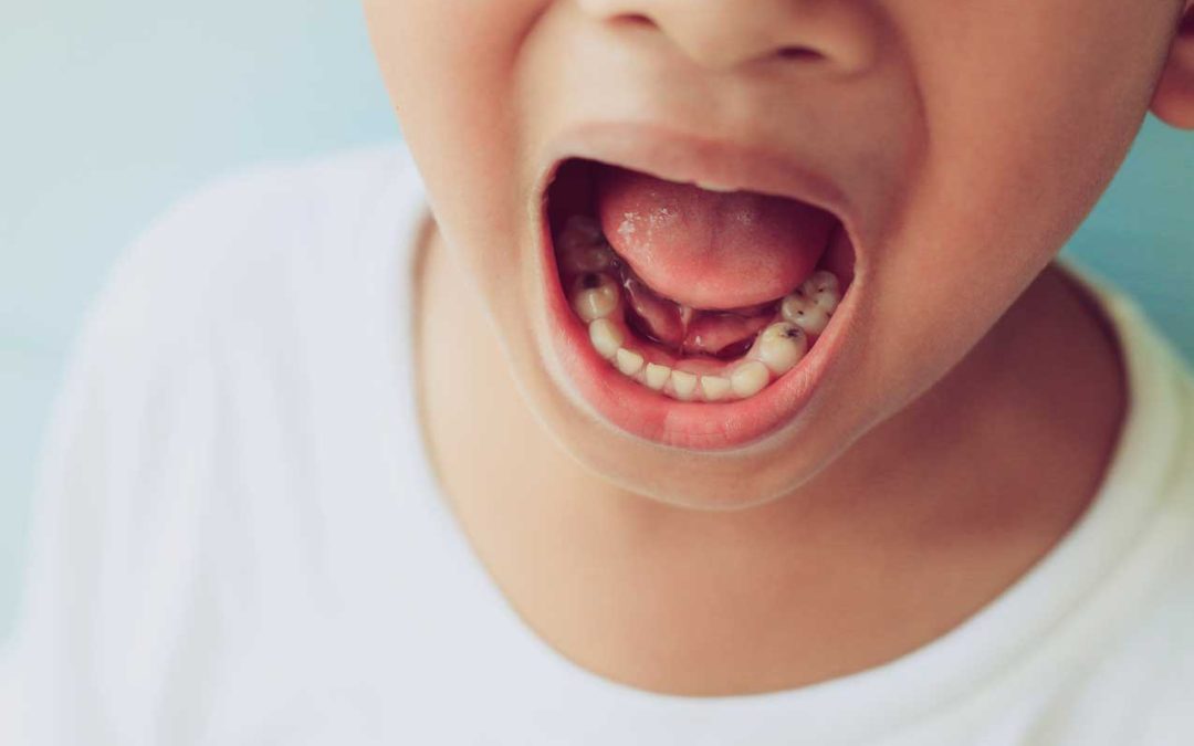Cavities in Baby Teeth