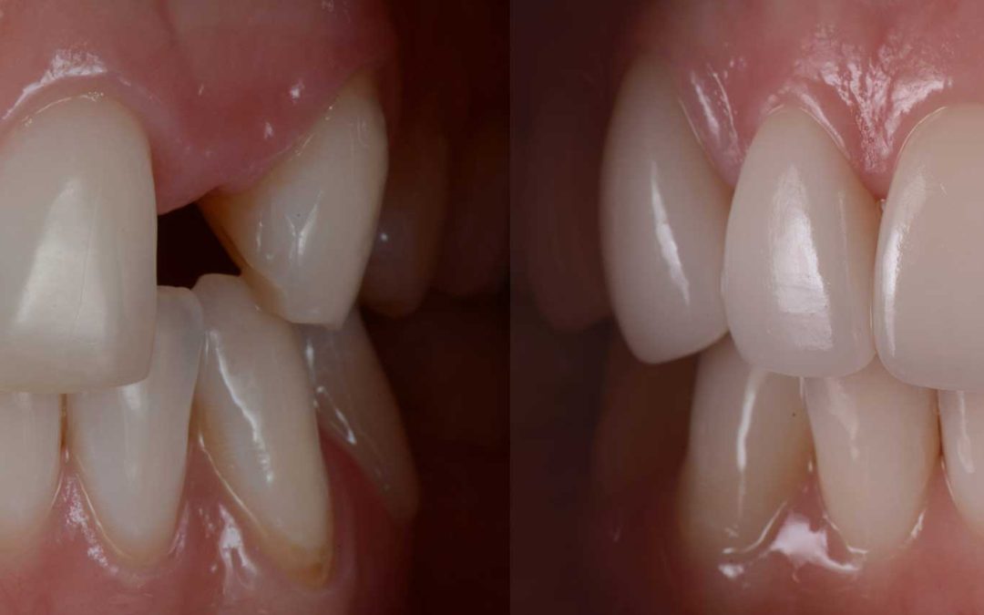 Comparing Dental Bridges VS Implants