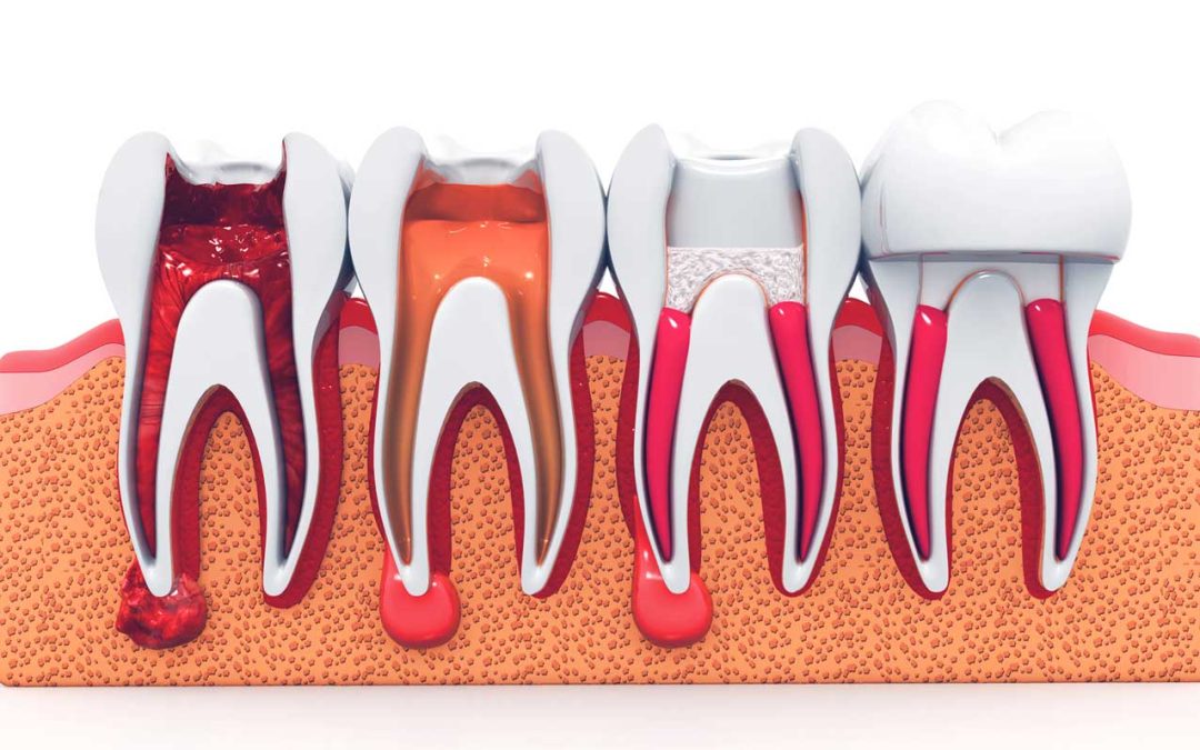 What Is a Root Canal Treatment?