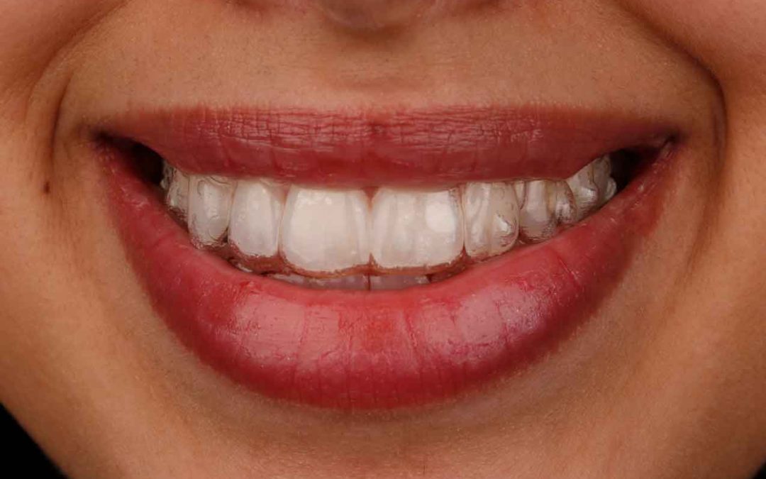 Straight Teeth Without Braces? How Invisalign Works